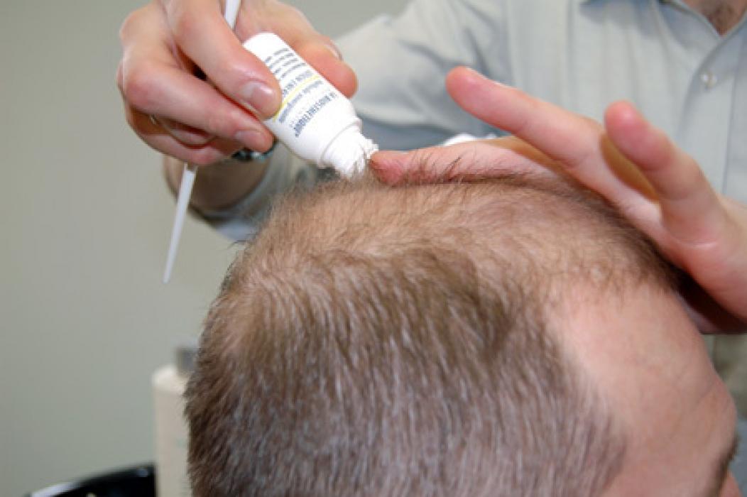 Выпадение волос дерматологи лечение выпадения волос
